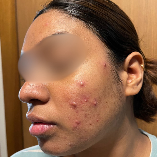 Acne Treatment